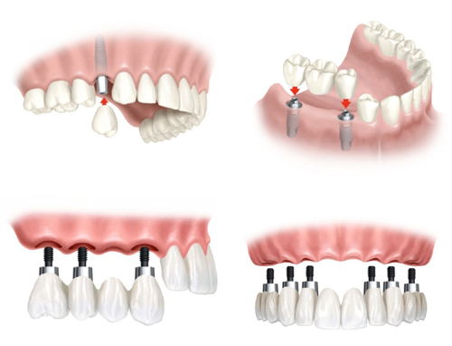 Trồng răng implant áp dụng thế nào tại nha khoa uy tín?-1