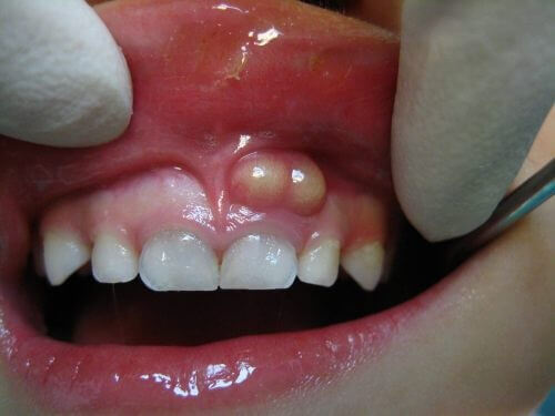 Viêm chân răng có mủ - Nguyên nhân và giải pháp 1