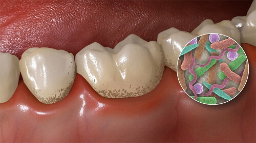 Viêm chân răng có mủ - Nguyên nhân và giải pháp 2