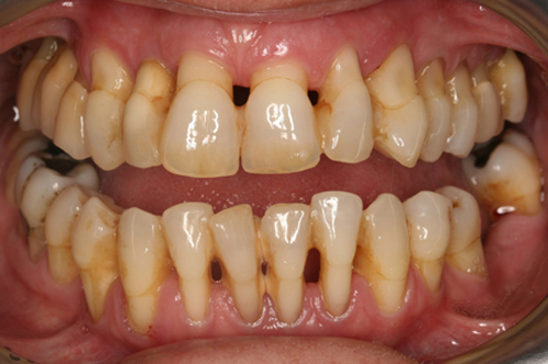 Viêm lợi hở chân răng là bệnh gì? Điều trị thế nào? 1