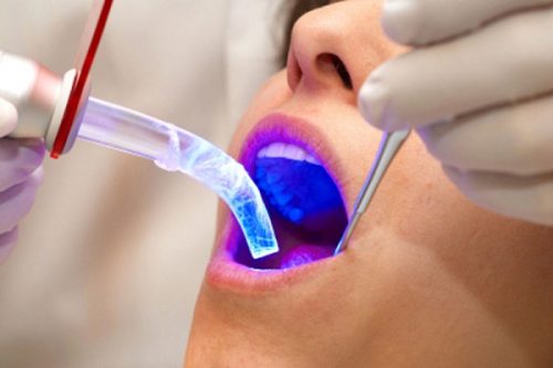 Viêm lợi hở chân răng là bệnh gì? Điều trị thế nào? 3
