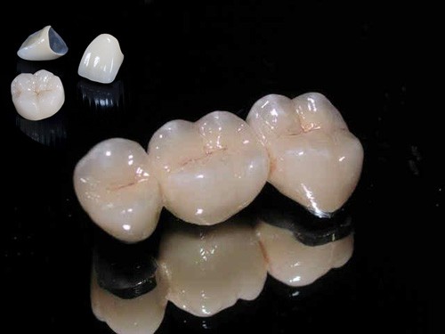 Bọc răng sứ titan 2