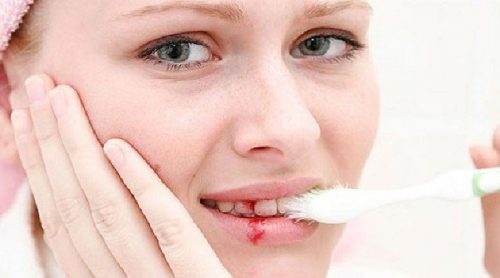 Chảy máu chân răng thường xuyên chữa trị bằng cách nào? 1