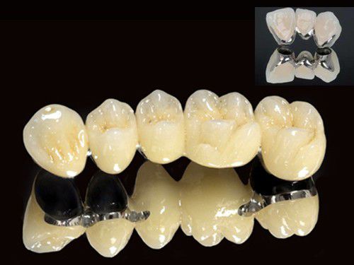 Độ bền của răng sứ thẩm mỹ 2