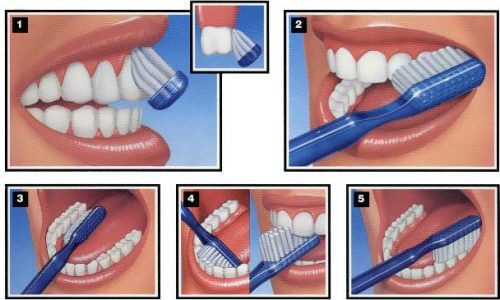 Độ bền của răng sứ thẩm mỹ 4
