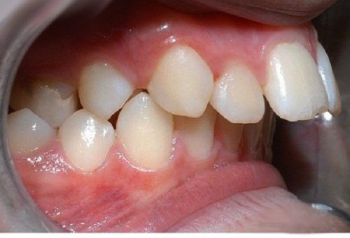 Niềng răng hô hàm trên 2