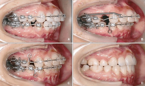 Niềng răng hô hàm trên 4