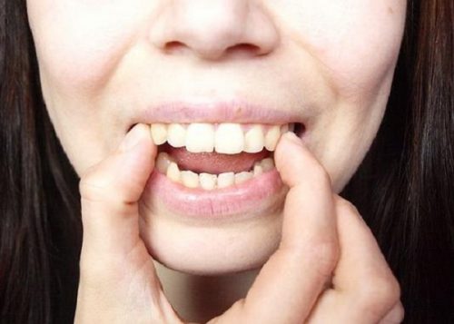 Phẫu thuật hàm hô bao lâu mới hồi phục? 1