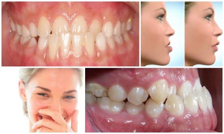 Phẫu thuật cắt xương hàm có nguy hiểm không?-1