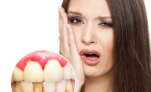 Viêm lợi chảy máu chân răng phải làm sao?1