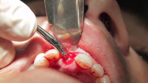 Bị viêm lợi trùm răng khôn phải làm sao? 3