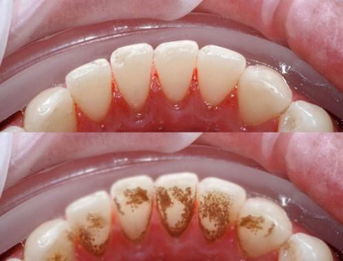 Lấy cao răng có ảnh hưởng không? 3
