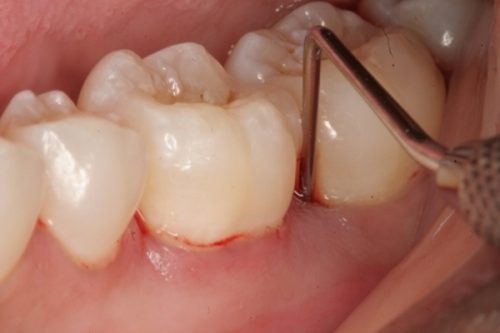 Lấy cao răng có đau hay không? Cần thông tin tìm hiểu 2