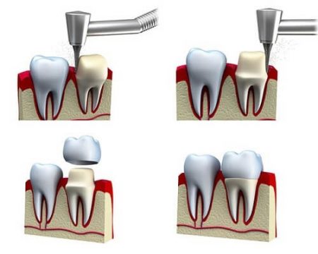 Nguyên nhân bọc răng sứ bị cộm - 3 ảnh hưởng do răng sứ bị cộm gây ra-2