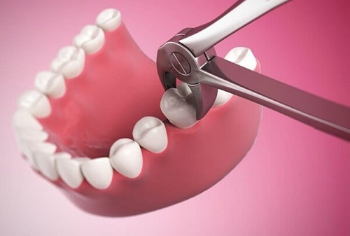 Nhổ răng hàm bao nhiêu tiền phụ thuộc vào các yếu tố nào? 2