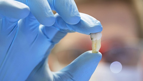 Nhổ răng hàm bao nhiêu tiền phụ thuộc vào các yếu tố nào?3