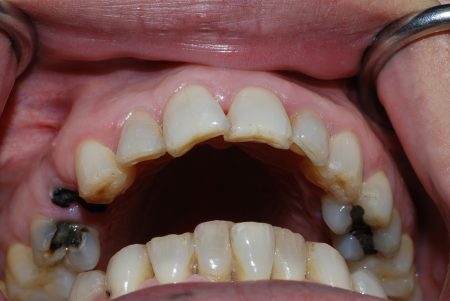 Nhổ răng hàm bao nhiêu tiền phụ thuộc vào các yếu tố nào?-1