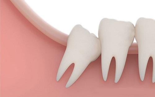 Nhổ răng khôn giá bao nhiêu tiền phụ thuộc vào điều gì? 1