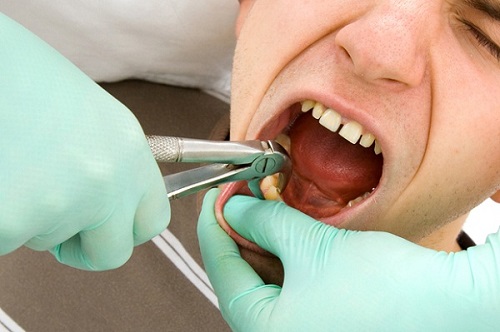 Nhổ răng số 8 có nguy hiểm không? Cần lưu ý điều gì? 2