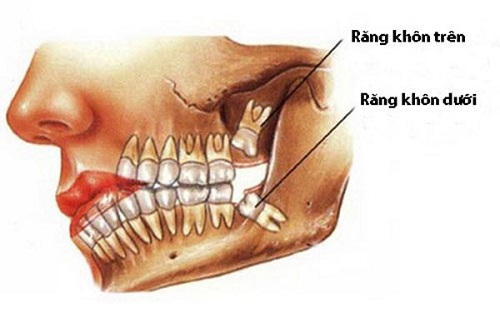 Răng khôn là răng số mấy mọc ở vị trí nào? 1