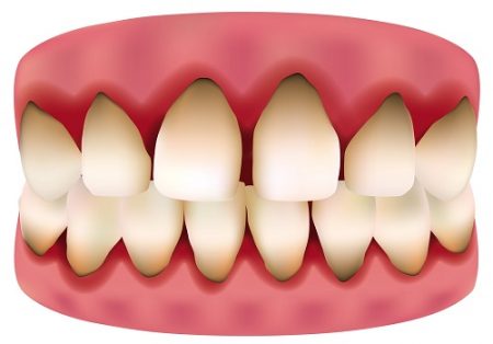 Cách khắc phục tình trạng răng sứ bị đen viền nướu-1