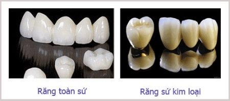 Cách khắc phục tình trạng răng sứ bị đen viền nướu-2
