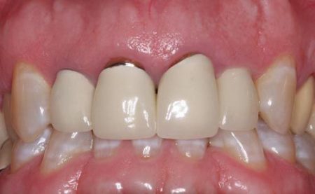 Răng sứ titan sử dụng được bao lâu thưa bác sĩ?-3
