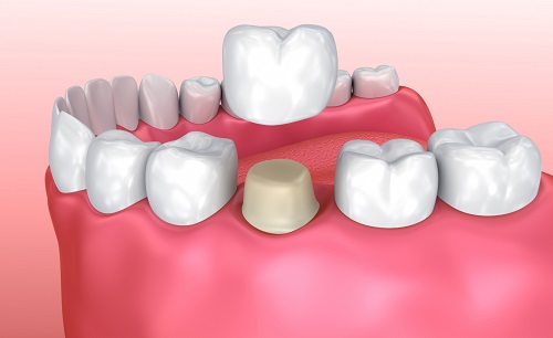 Trồng răng sứ có đau không? Phương pháp trồng răng sứ 1 Trồng răng sứ có đau không? Phương pháp trồng răng sứ 1
