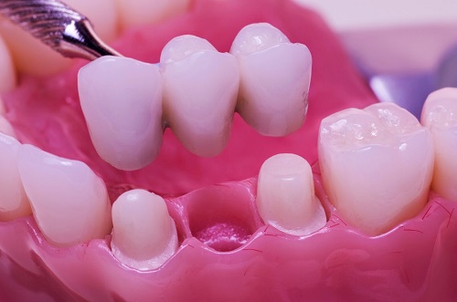 Trồng răng sứ có đau không? Phương pháp trồng răng sứ 2 Trồng răng sứ có đau không? Phương pháp trồng răng sứ 2