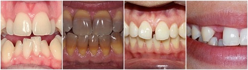 Bọc răng sứ cercon được đánh giá cao về thẩm mỹ 2