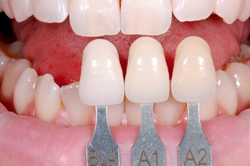 Bọc răng sứ giá rẻ có nên thực hiện không? 1