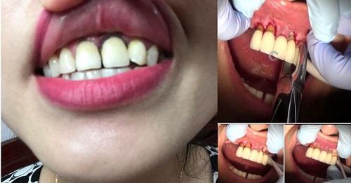 Bọc răng sứ giá rẻ có nên thực hiện không? 2 Bọc răng sứ giá rẻ có nên thực hiện không? 2