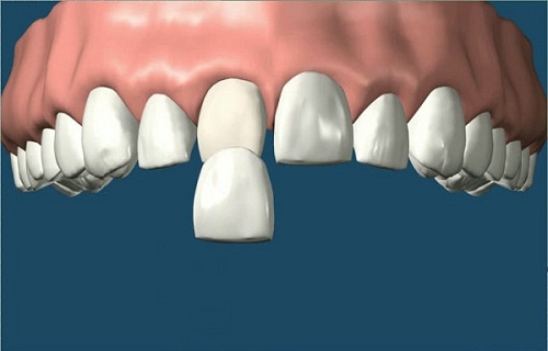 Phương pháp bọc răng sứ không cần mài răng hiệu quả nhất cho bạn-1