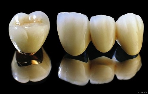 Bọc răng sứ kim loại có tốt không khi bọc răng gãy vỡ? 1 Bọc răng sứ kim loại có tốt không khi bọc răng gãy vỡ? 1