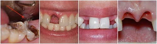 Bọc răng sứ kim loại có tốt không khi bọc răng gãy vỡ? 2