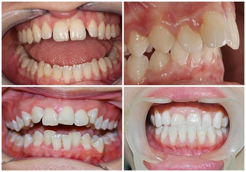 Chi phí niềng răng mắc cài tự đóng tốt nhất cho khách hàng 1