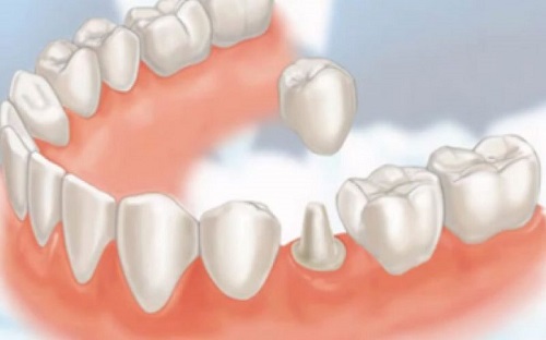 Những yếu tố để xác định chụp răng sứ giá bao nhiêu là thực hiện được-2