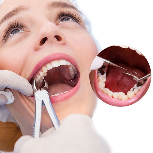 Hiện nay nhổ răng sâu ở đâu an toàn nhất ? 1