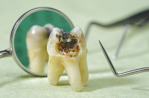 Hiện nay nhổ răng sâu ở đâu an toàn nhất ? 2