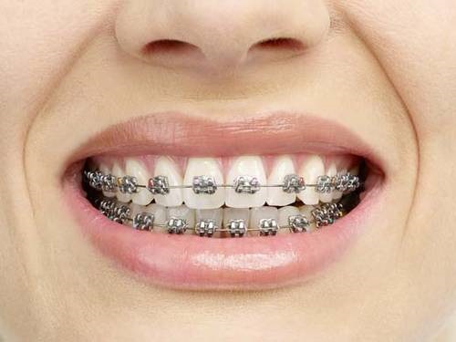 Niềng răng có đắt không? Thông tin cần biết về niềng răng-1