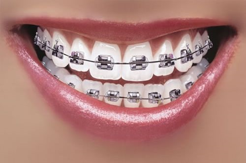 Niềng răng có hại gì không? Mặt tích cực của dịch vụ niềng răng-1