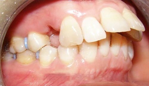 Thực hiện niềng răng có hết hô không bác sĩ?-1