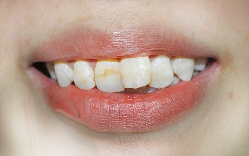 Niềng răng cửa bị mọc lệch nâng cao tính thẩm mỹ cho răng-1