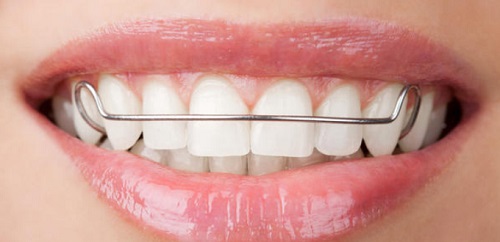 Niềng răng cửa bị mọc lệch nâng cao tính thẩm mỹ cho răng-2
