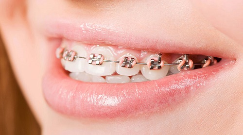 Niềng răng cửa bị mọc lệch nâng cao tính thẩm mỹ cho răng-3