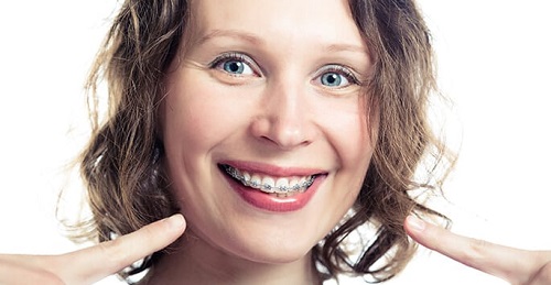 Niềng răng khểnh giá bao nhiêu? Kết quả niềng răng có liên quan đến giá cả không?-3