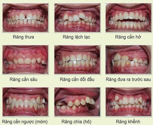 Niềng răng không mắc cài thẩm mỹ hiệu quả an toàn 1