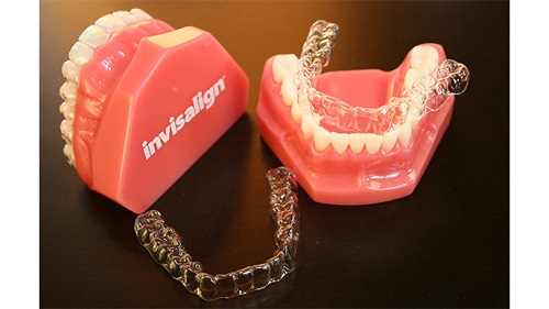 Niềng răng không mắc cài thẩm mỹ hiệu quả an toàn 3