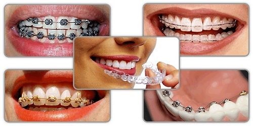 Niềng răng lệch lạc bằng mắc cài 3D Speed hiện đại 2
