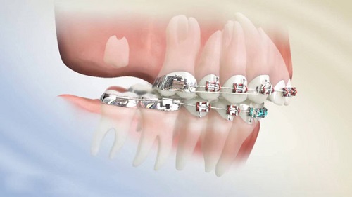 Niềng răng mắc cài tự đóng rút ngắn số lần tái khám 4